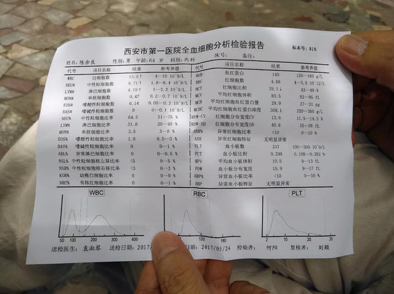 嗜碱性粒细胞百分比偏高是什么原因(血常规检查中) - 百百科