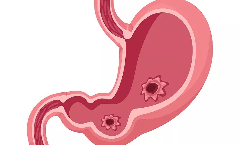 醫生:身體出現這4個症狀,你的胃已經在穿孔的路上了