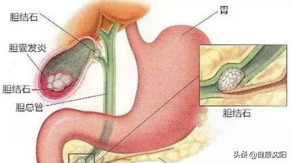 把健康帶回家 | 得了膽囊結石怎么办？