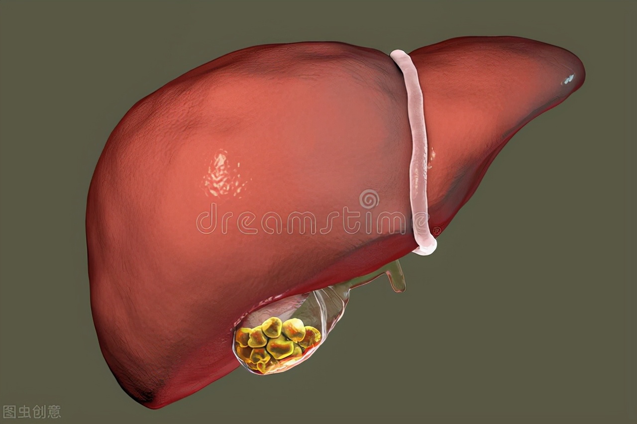 患者：膽管結石會引起肝硬化、肝癌嗎