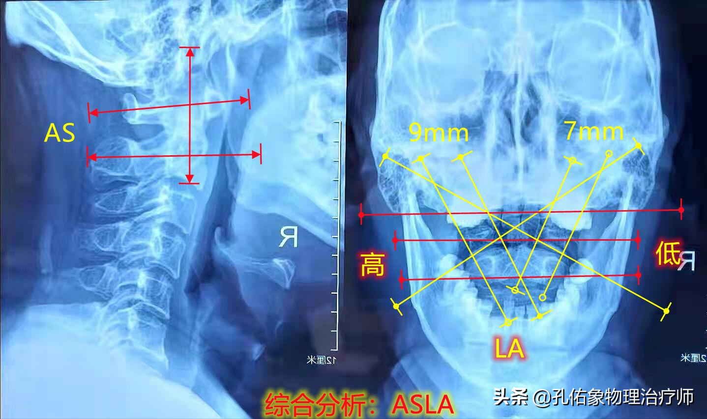 颈椎病的人，做了核磁共振检查，有用吗？不要再瞎折腾了