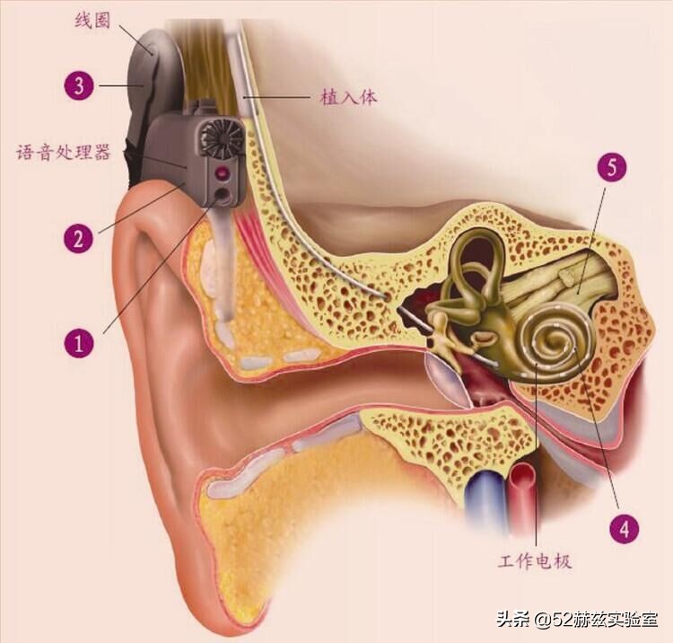 进口人工耳蜗要30万？国产货硬气说不，打破国外垄断