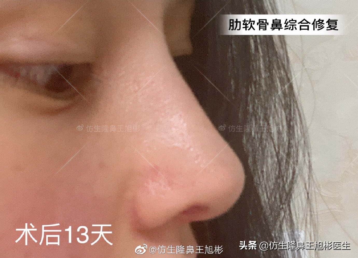 广州隆鼻科普：王旭彬鼻整形修复案例分享