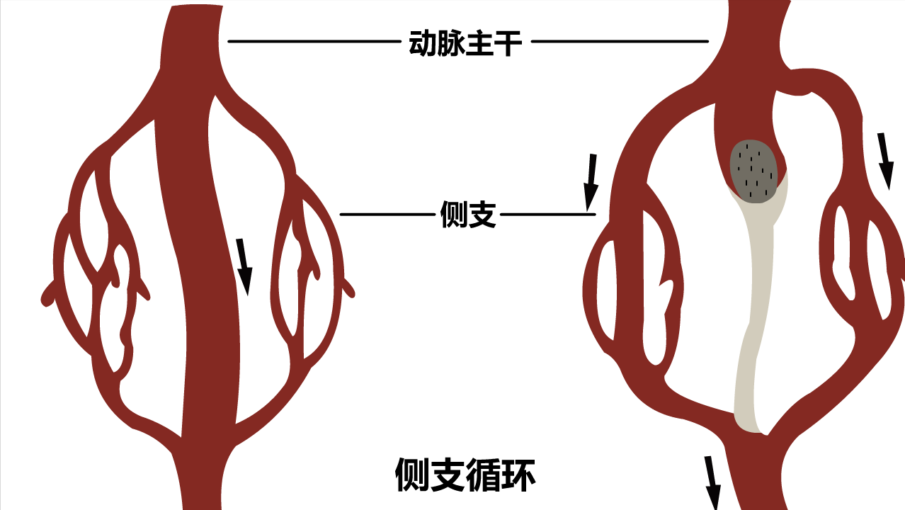 孩子确诊先心病——左冠状动脉异常起源于肺动脉，还有得治吗？