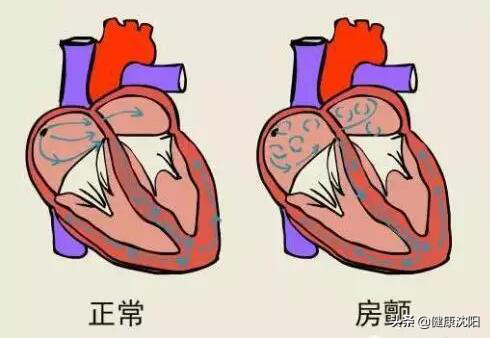 中国房颤日 | 关于“房颤”，你想知道的都在这里