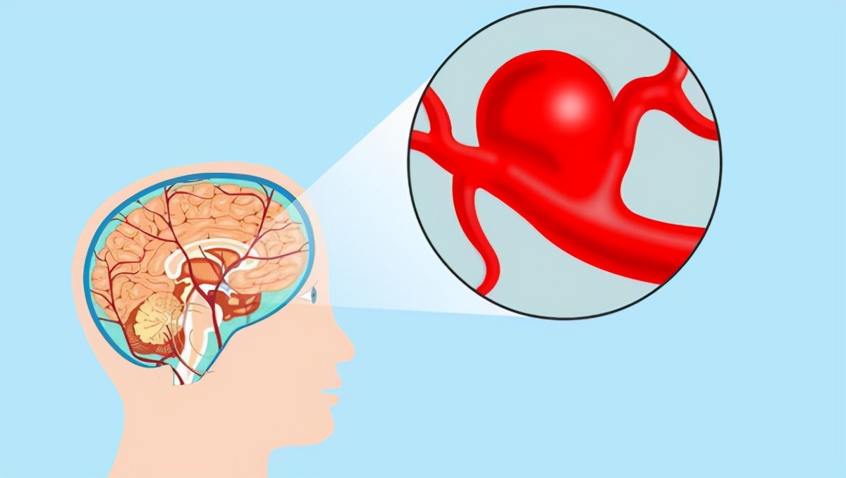 5个症状提示脑供血不足？改善做好这4点，保护脑血管