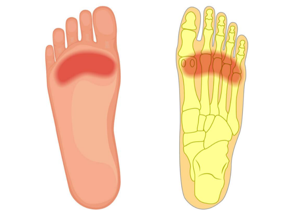 脚的部位名称图和图片(一份“双脚疼痛图解”，详解不同位置脚疼原因)