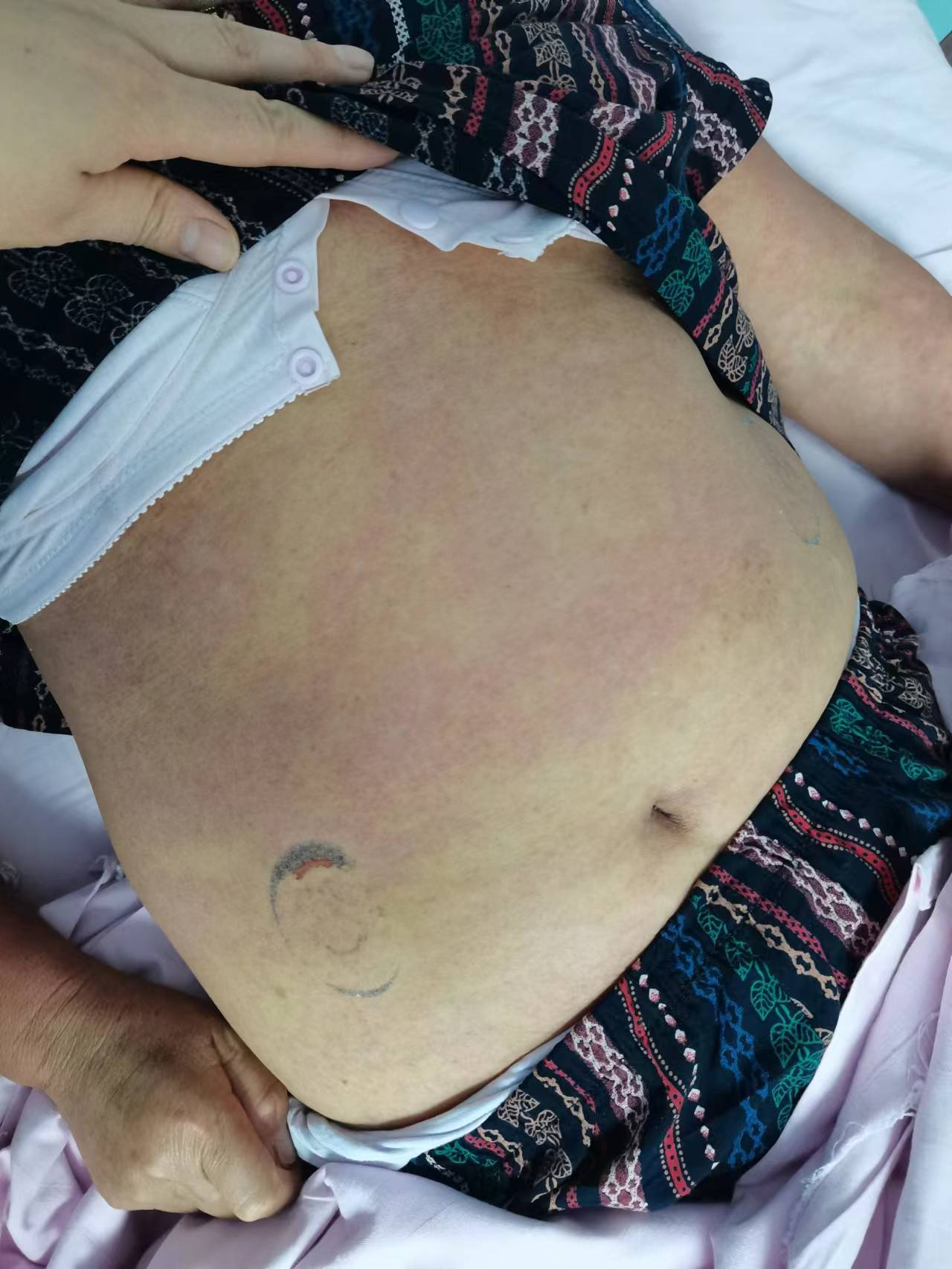 生命相托 用心守护—郫都区中医院皮肤科全力抢救危重药物过敏患者