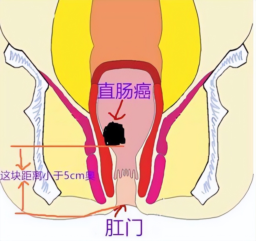 结肠癌位置图片