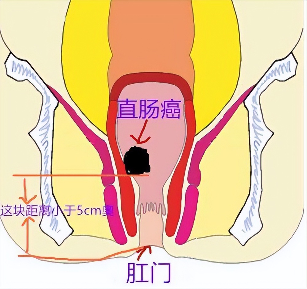 是消化道常見的惡性腫瘤之一,直腸癌位置低,容易被直腸指診及乙狀結腸