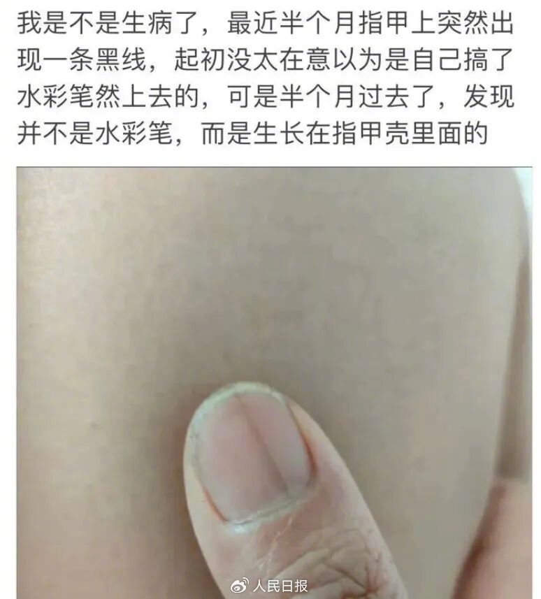 指甲出现这个变化别不当回事