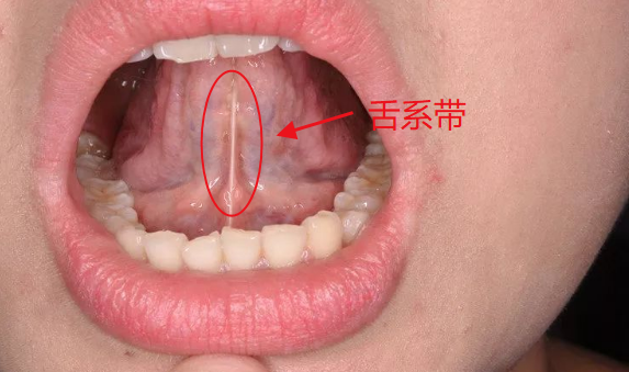 mm口腔喉咙舌根图片