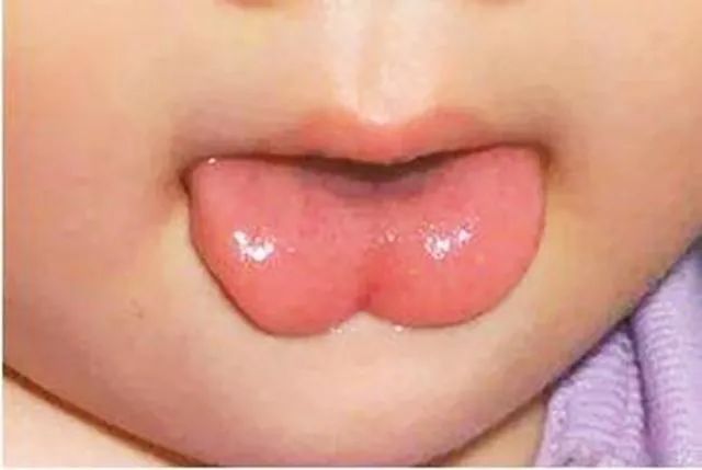 新生儿舌头短图片