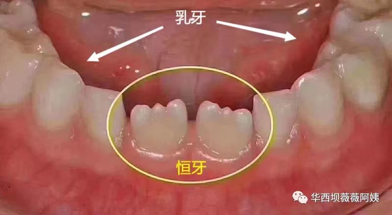 過年回家被人說孩子牙齒長醜了要箍?華西口腔專家教你辨別