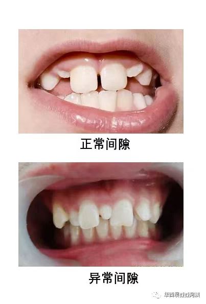 答:正如之前讲到的,这可能是因为还没有长出来的侧切牙(侧门牙)在骨头