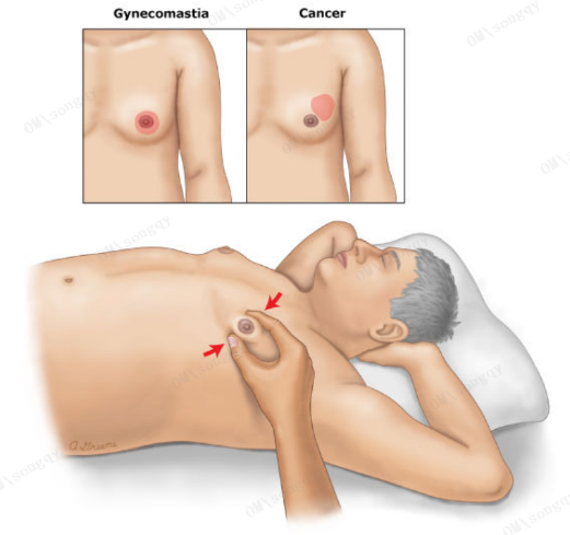 青春期男孩乳房发育直径长达4cm，是性早熟还是另有原因？