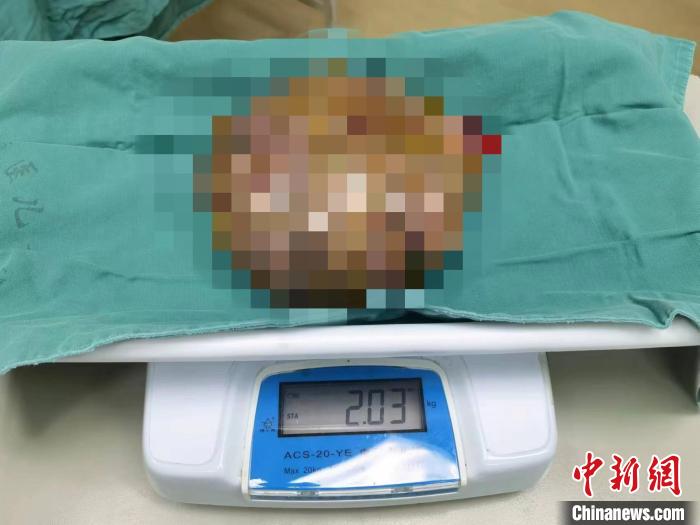 重庆11.6斤新生婴儿自带4斤肿瘤 肿瘤外科专家手术摘除