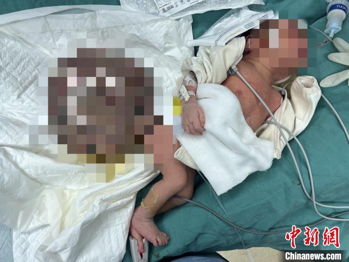 重庆11.6斤新生婴儿自带4斤肿瘤 肿瘤外科专家手术摘除