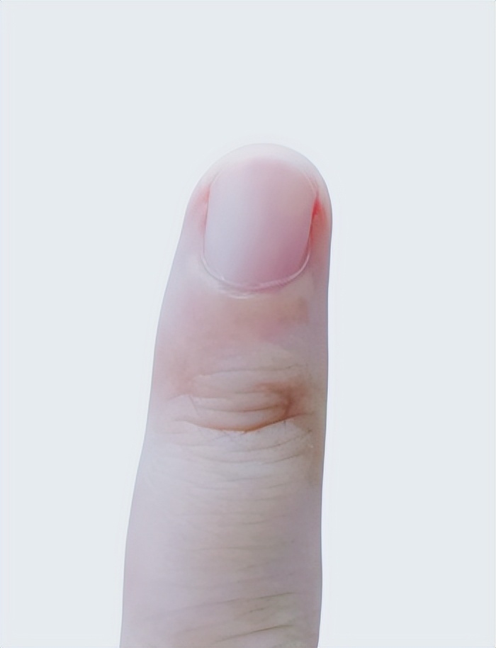 指甲出现这个变化别不当回事