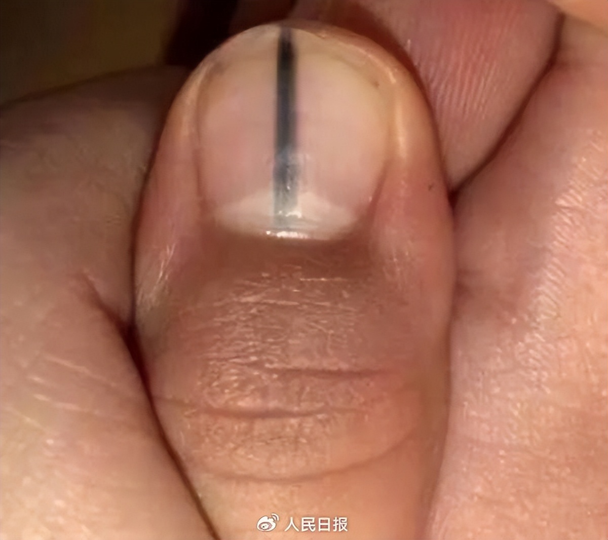 指甲出现这个变化别不当回事