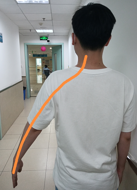 肩周炎三个动作自愈方法视频，肩周炎三个动作自愈方法（他得了两年的肩周炎竟然好了）