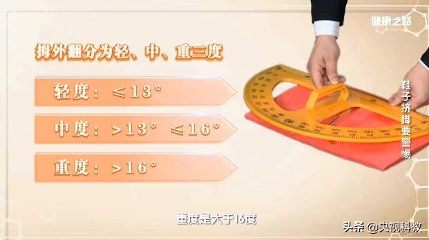 小拇指外翻怎么矫正，让你又丑又疼的拇外翻矫正方法在这里