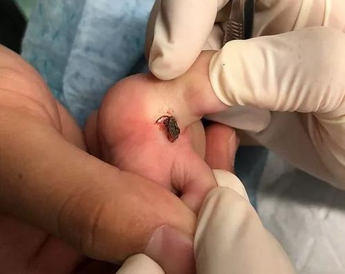 身上长血痂点怎么办,血痂长在皮肤下边了怎么办("小血痂"竟会是孩子的