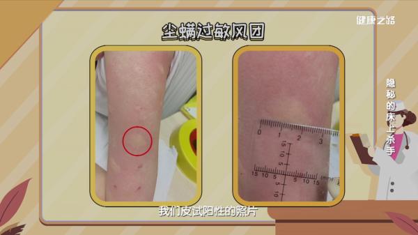 螨虫的危害有多大，螨虫有什么危害吗（500万螨虫陪你睡）