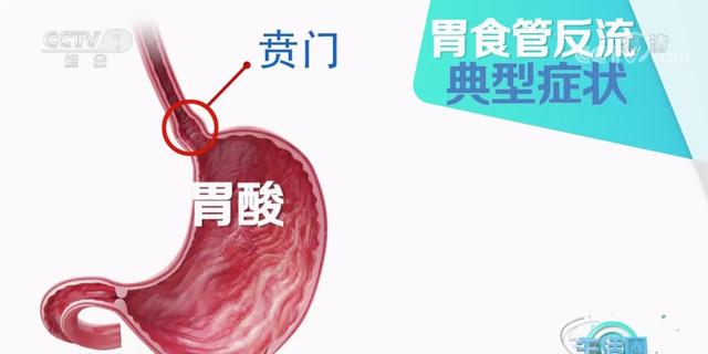 吃完饭烧心是什么原因，吃完饭感觉烧心是怎么回事（常常饭后“烧心”）