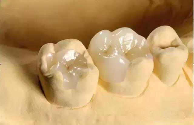 嵌体和补牙的区别，嵌体与补牙之间的区别（有种补牙叫嵌体）